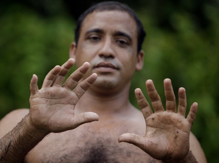 Người đàn ông sở hữu 24 ngón chân tay hoàn hảo - 1