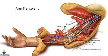 Binh sĩ Mỹ mất tứ chi được ghép 2 cánh tay - 4 Đồ hoạ mô phỏng việc nối ghép một cánh tay của Marrocco