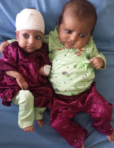 Bé Gul (bên trái) nhỏ con hơn so với chị gái song sinh.