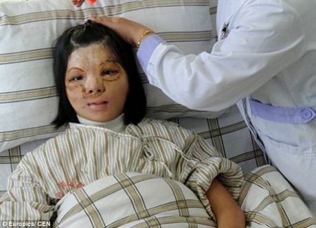 Cô gái bị bỏng mặt thay đổi hoàn toàn sau ca cấy da - 2 Gương mặt của Xu Jainmei đã thay đổi hoàn toàn sau ca cấy ghép da.