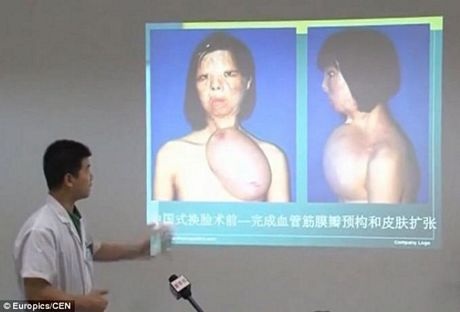 Cô gái bị bỏng mặt thay đổi hoàn toàn sau ca cấy da - 4 Xem video: