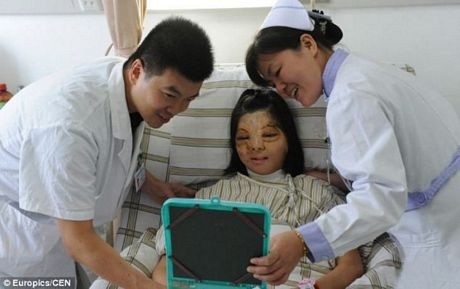 Cô gái bị bỏng mặt thay đổi hoàn toàn sau ca cấy da - 3 Gương mặt của Xu Jainmei đã thay đổi hoàn toàn sau ca cấy ghép da.