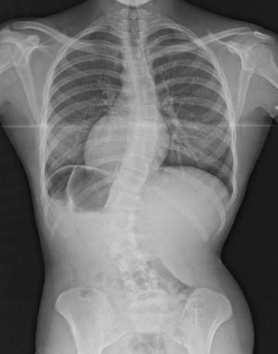 Thiếu nữ có cột sống xoắn hình chữ S - 2 Ảnh chụp X-quang cho thấy đoạn cột sống bị xoắn trong cơ thể Roberts.