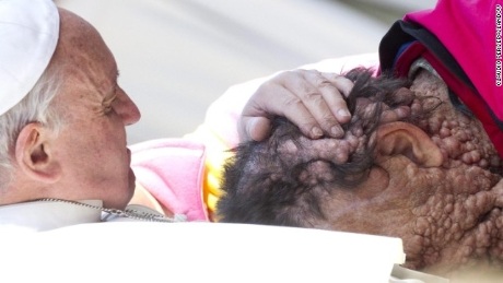 Chuyện "người đàn ông mặt quỷ" ôm chặt Giáo hoàng - 2 Giáo hoàng Francis ôm chặt
Vinicio.