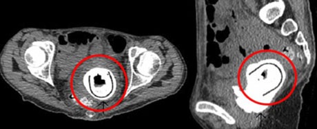 Bỏ quên đồ chơi tình dục trong người suốt 10 năm - 1 Hình ảnh chụp X-quang cho thấy vật thể lạ trong người một bệnh nhân.