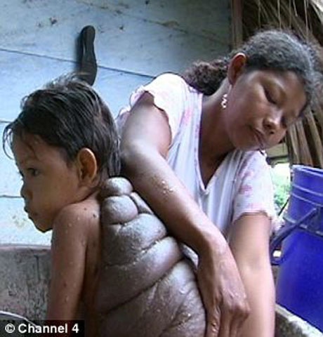 Cậu bé có vết bớt "khủng" như mai rùa - 2 Didier Montalvo trước khi được phẫu thuật.