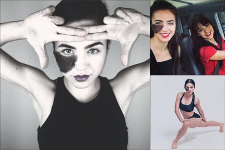 Vẻ đẹp rạng ngời của nữ vũ công trẻ bị chàm nửa mặt