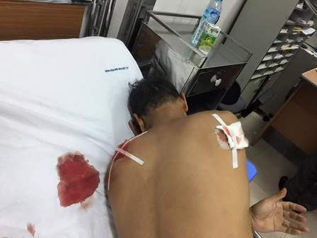 Đâm trọng thương hàng xóm, vẫn "vô sự" về nhà? - 2
Vết thương thấu phổi trên cơ thể bệnh nhân Lưu ( ảnh CTV)