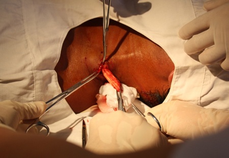 Phát hiện thanh gỗ dài 7cm nằm sâu trong cổ  - 2