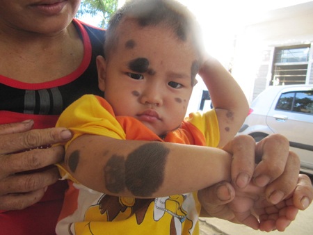 Mong manh sự sống cháu bé 2 tuổi bị u sắc tố da - 1 Mong manh sự sống cháu bé 2 tuổi bị u sắc tố da - 1