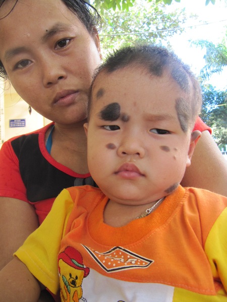 Mong manh sự sống cháu bé 2 tuổi bị u sắc tố da - 2 Mong manh sự sống cháu bé 2 tuổi bị u sắc tố da - 2