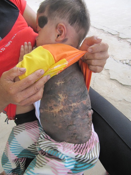 Mong manh sự sống cháu bé 2 tuổi bị u sắc tố da - 3 Mong manh sự sống cháu bé 2 tuổi bị u sắc tố da - 3