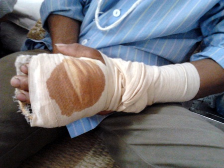 Anh Tuyên bị người nhà ông Dự chém nhiều nhát vào tay.