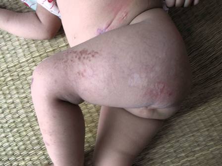 Xót xa trước bé 1 tuổi dị dạng bộ phận sinh dục