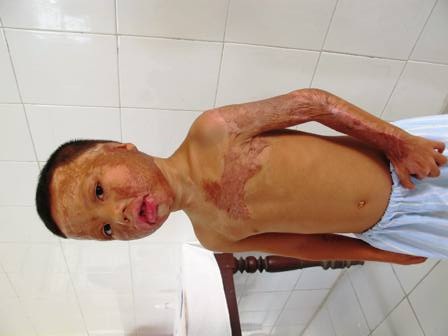 Phẫu thuật miễn phí cho bệnh nhân di chứng bỏng có hoàn cảnh khó khăn