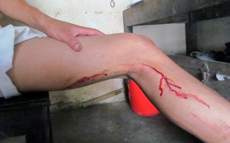 Bị lợn rừng tấn công, hai người phải khâu nhiều mũi - 4 Vết thương của anh Thứ bị lợn tấn công ở tay và chân (Ảnh: M.T).