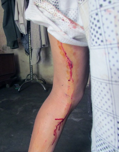 Vết thương của anh Thứ bị lợn tấn công ở tay và chân (Ảnh: M.T).