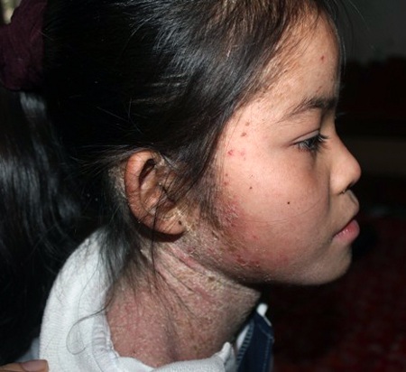 Trong người, trên cổ và mặt đều bong tróc những da khiến Trang đau đớn, buồn bà...