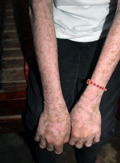 Chân tay cháu Trang bong tróc từng mảng như một cụ già mắc bệnh lâu năm. 