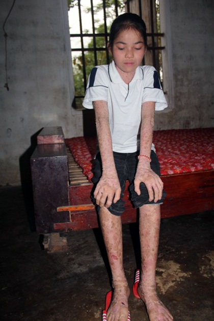 Cháu Trang luôn mang nỗi buồn vô hạn. Trang ước mơ được khỏi bệnh để được đến trường.