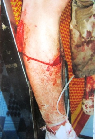 Với những vết chém đó, anh Lương được đưa đi giám định với tỷ lệ thương tật 23%.