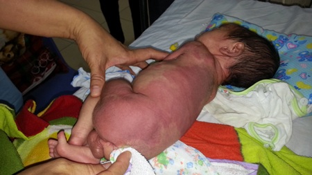 Cháu Hưng bị u máu, kèm theo viêm phổi, vàng da...