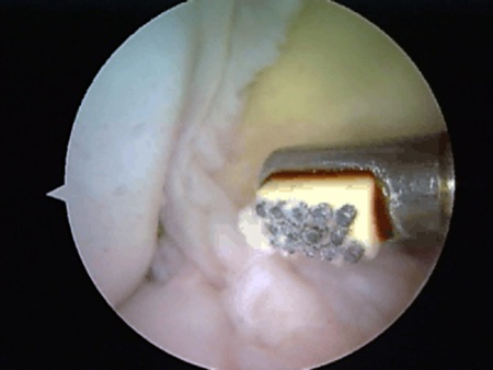  Hình ảnh nội soi trên màn hình do các bác sỹ BV115 Nghệ An thực hiện.