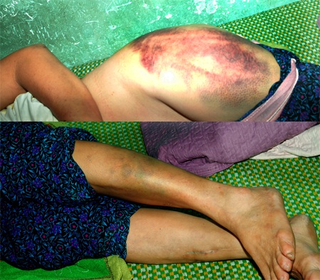 Những vết bầm tím trên cơ thể bà Thìn (Ảnh do gia đình cung cấp).