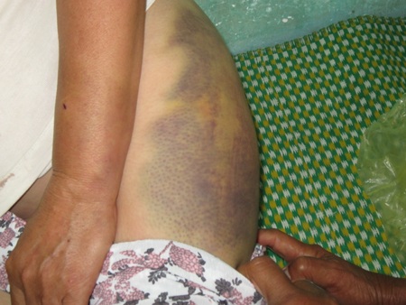 Những vết bầm tím trên cơ thể bà Thìn (Ảnh do gia đình cung cấp).