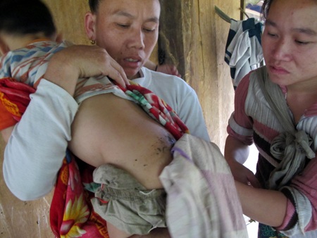 Hiện bé Đức mủ vẫn chảy ra và rất đau đớn.