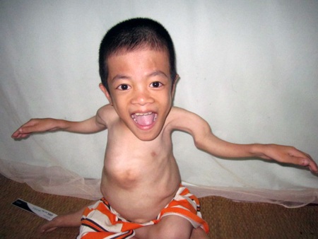 Đôi tay cong queo, nhưng Vinh luôn cười tươi hạnh phúc