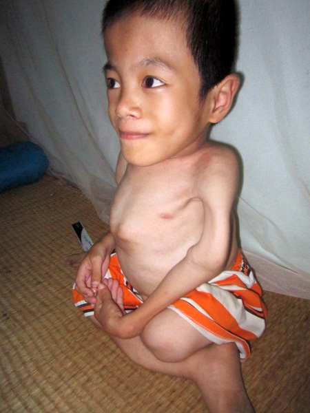 Bé Vinh bị căn bệnh xương thủy tinh hành hạ, nhưng em lúc nào cũng vui tươi và hóm hỉnh.