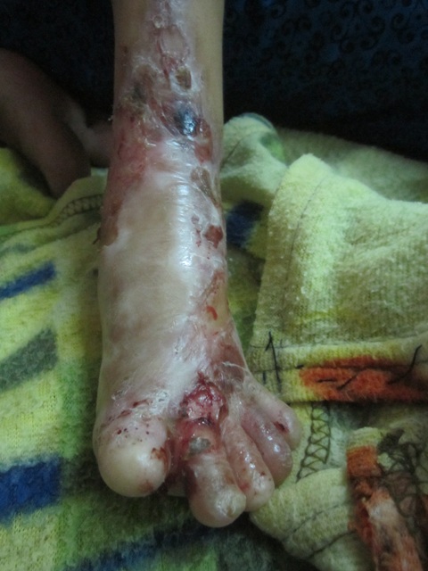 Chân tay, người cháu đều bị bỏng tróc từng lớp da thịt.