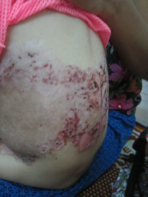 Chỗ nào trên cơ thể bé cũng bị lở loét.