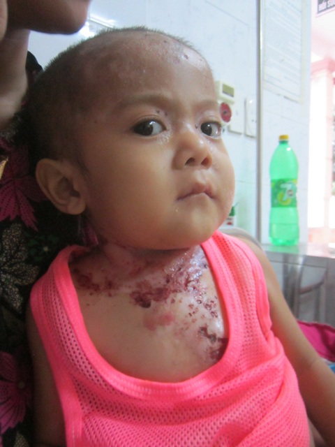 Chỗ nào trên cơ thể bé cũng bị lở loét.