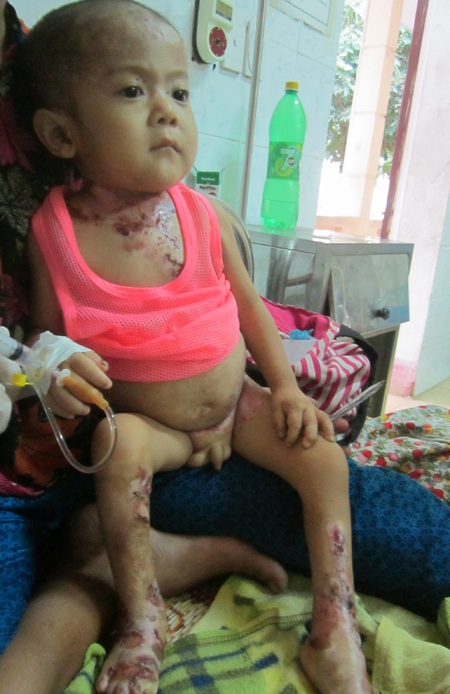 Chân tay, người cháu đều bị bỏng tróc từng lớp da thịt.