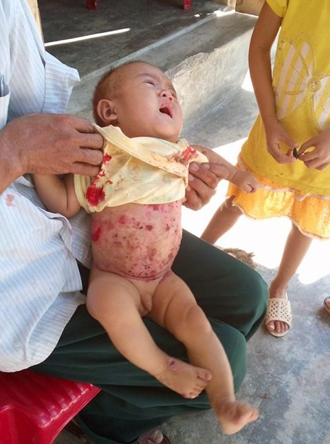 Bong tróc từng lớp da... cháu khóc trong đau đớn.