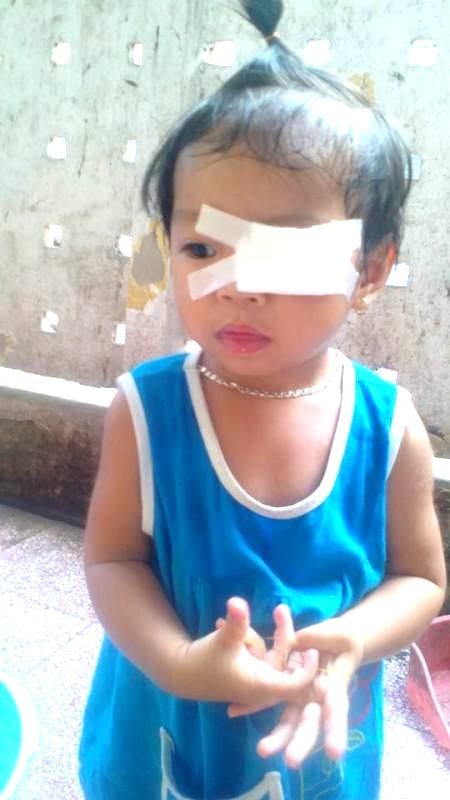 “Mẹ ơi, mắt con... rơi rồi” - 8 Bé Nguyễn Lê An Mi lúc mới mổ mắt ở Bệnh viện mắt Trung ương. Tuy