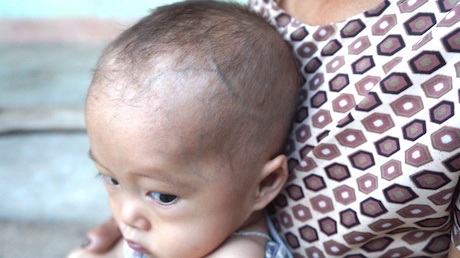 Mắc bệnh tim bẩm sinh, bé 15 tháng tuổi dặt dẹo như sợi bún - 4 Trên đầu, mặt... thì những đường gân xanh nổi lên rõ trông thấy.