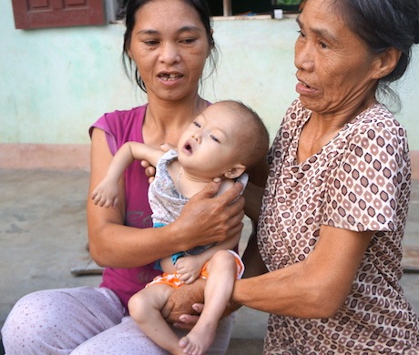 Mắc bệnh tim bẩm sinh, bé 15 tháng tuổi dặt dẹo như sợi bún - 17 Bé Gia Bảo đã yếu lắm rồi, mong các chú giúp với, anh Thiên người dẫn chúng tôi nói như cầu cứu.