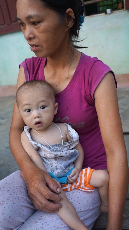 Mắc bệnh tim bẩm sinh, bé 15 tháng tuổi dặt dẹo như sợi bún - 8 Mẹ cháu nói, chưa bao giờ nghe tiếng con cười một lần dù đã 15 tháng tuổi kể từ ngày sinh.