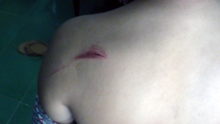 Vết thương trên vai Trung úy Đậu Hoàng Song do bị các đối tượng đánh.