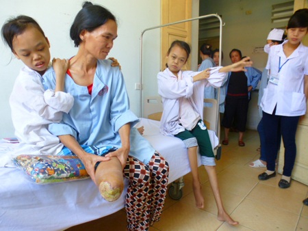 Chân em Hiền đã cụt một bên ngày xuống bệnh Ŷiện.