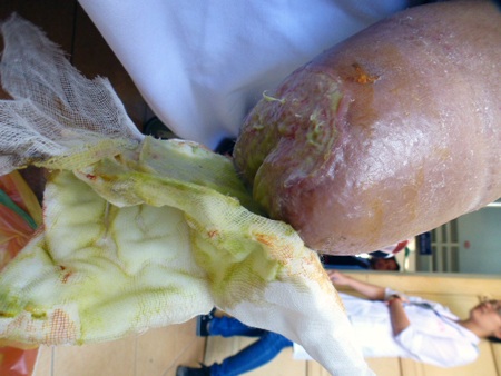 Chân bé Hậu giờ đã cụt...