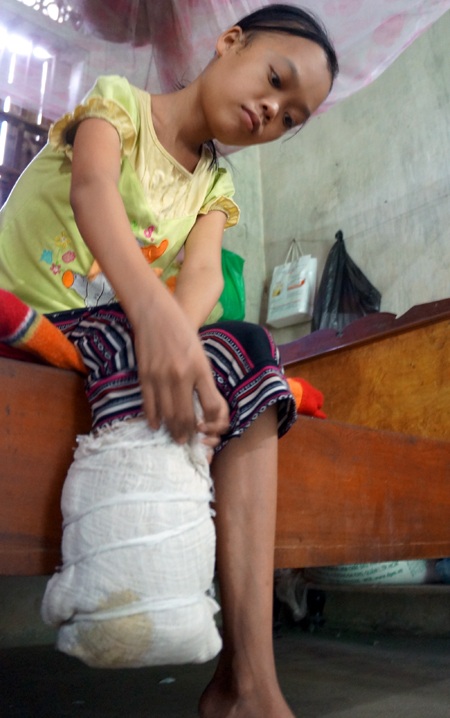 Hiện bé Hòa đã bị căn bệnh ăn mất một chân như thế này.