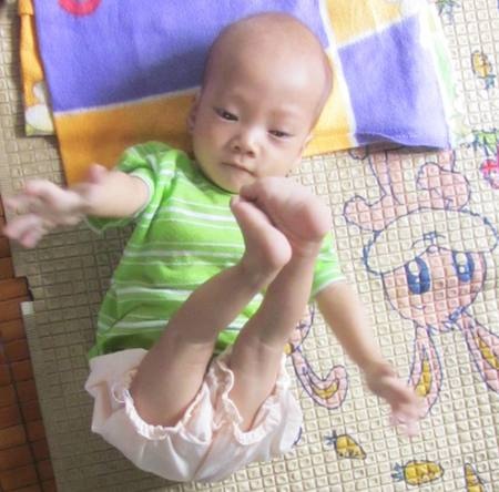 Bé An 11 tháng tuổi bị tim bấm sinh phức tạp, còi cọc như em bé sơ sinh.