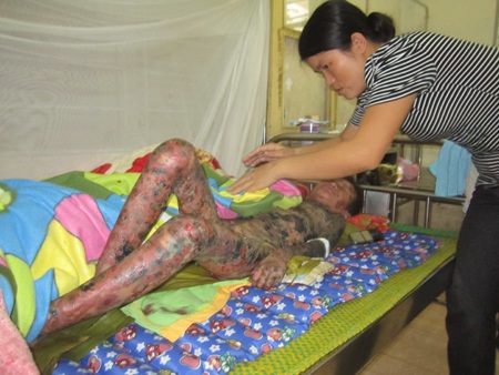 Chị Việt phải chăm sóc cháu cẩn thận từng li từng tí, nếu không cháu Bách sẽ bị nhiễm trùng.