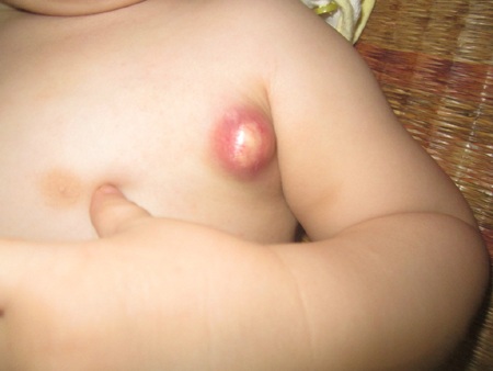 Một khối thịt đã bắt đầu lồi ra và càng ngày càng phát triển nh