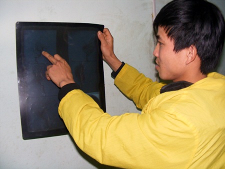 Tình cảnh nguy kịch của cậu bé mắc bệnh dị dạng mạch máu não