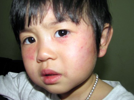 Cháu bé 2 tuổi bị cô giáo dùng thước đánh vào mặt 